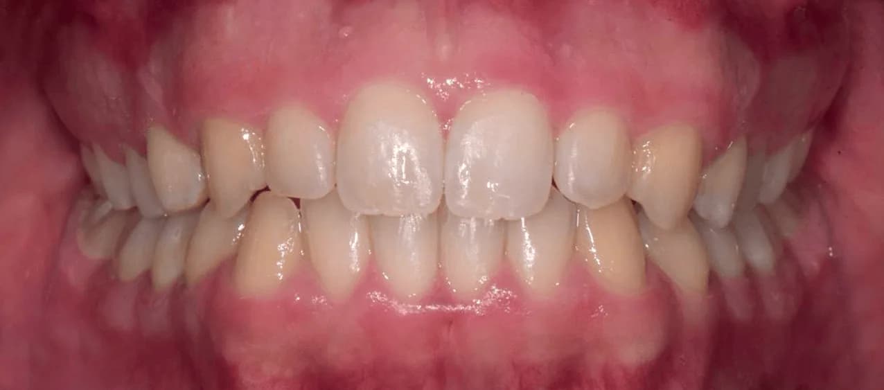 Affollamento dentale — dopo il trattamento
