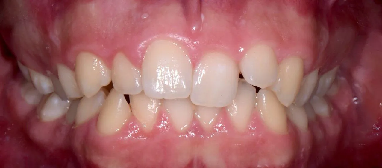 Affollamento dentale — prima del trattamento